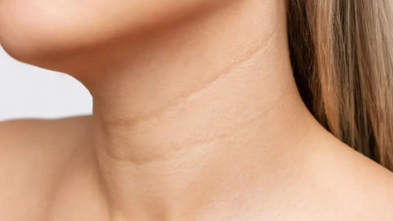 What Is Tech Neck Wrinkles? 5 Amazing Treatments